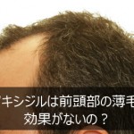 ミノキシジルは生え際（前頭部・M字）の薄毛に効果がないの？