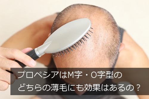 男性の薄毛