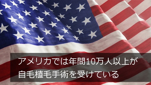 アメリカで自毛植毛手術