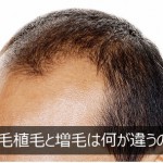 自毛植毛と増毛は何が違うの？【2つの薄毛改善手法を比較】