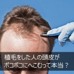 植毛手術をした人の頭皮がボコボコにへこむって本当？