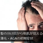 髪の分け目から地肌が見えるのは薄毛・AGAの初期症状