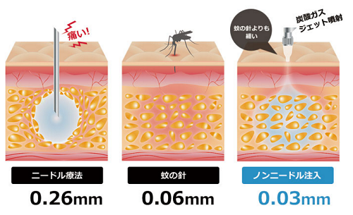 ノンニードル注入法