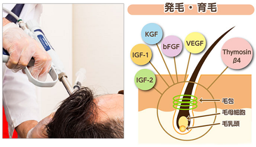 グロースファクター毛髪再生