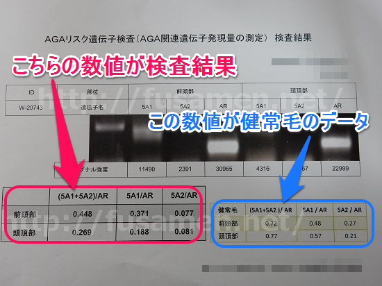 AGAリスク遺伝子検査の結果