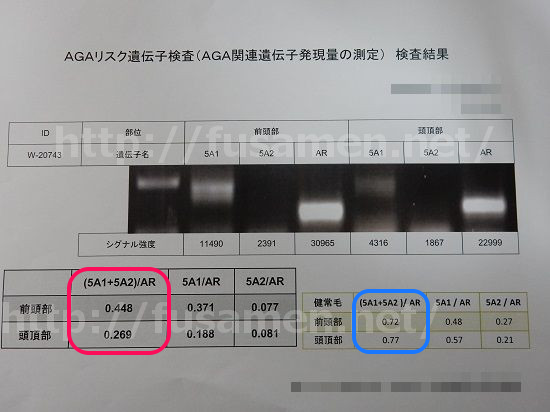 AGAリスク遺伝子検査の結果その2