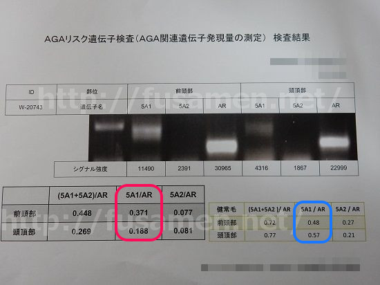 AGAリスク遺伝子検査の結果その3