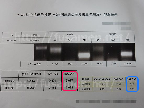 AGAリスク遺伝子検査の結果その4