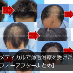 ヘアメディカルで薄毛治療を受けた効果【ビフォーアフターまとめ】