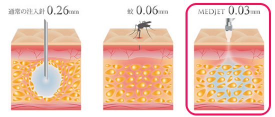 メドジェットの針