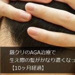 銀クリのAGA治療で生え際の髪がかなり濃くなった【10ヶ月経過】