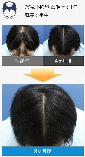 薄毛治療ヘアメディカル